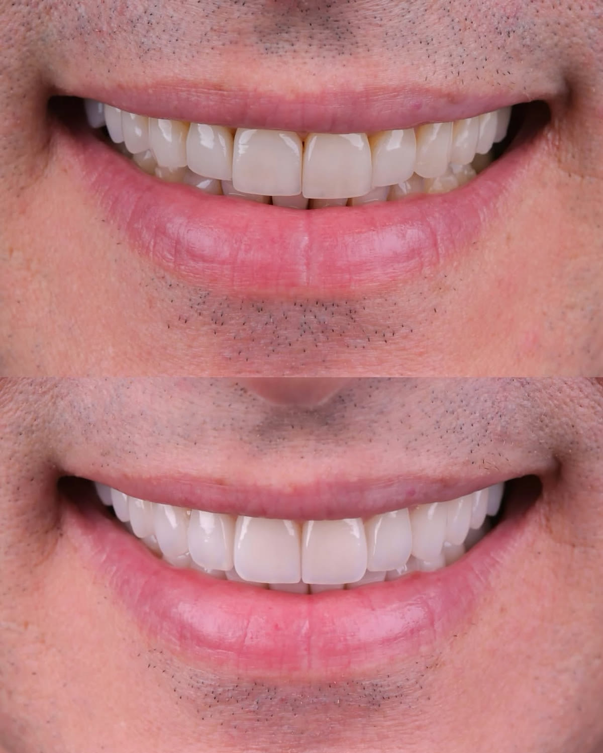 Comparativo de um mesmo sorriso