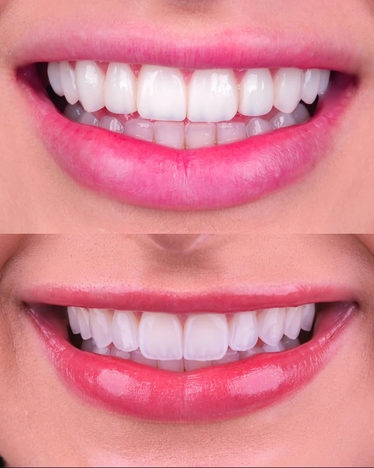 Segundo comparativo de um mesmo sorriso